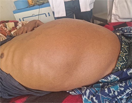 Picture showing hugely distended abdomen.