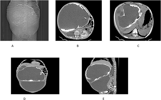 (A) Scout view showing a large intra-abdominal mass with peripheral calcification. (B) Axial view highlighting a hepatic cyst and an atrophied right kidney with a thinned-out cortex. (C) Axial view depicting a right pleural fluid collection, a hepatic cyst, and two active daughter cysts. (D, E) Coronal and sagittal views depicting the hepatic cyst and the peritoneal cyst (white cross).