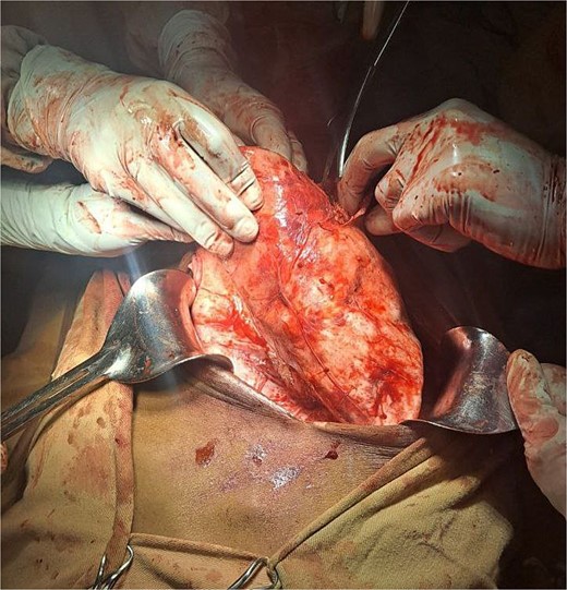 A large intrahepatic mass communicating with a massive peritoneal cystic mass.