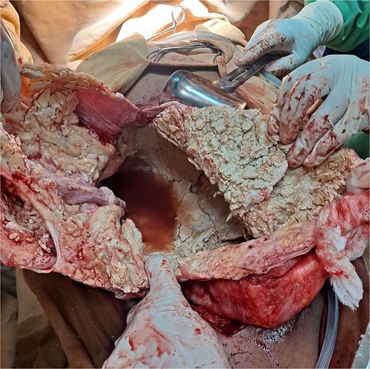 A calcified capsule with evacuated hydatid debris.