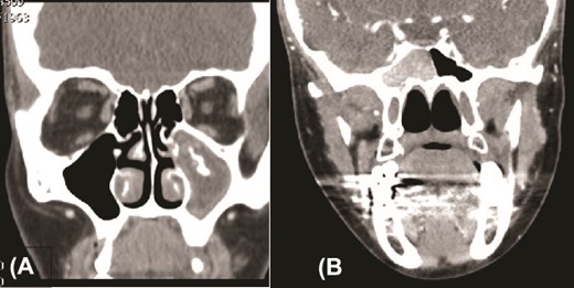 Paranasal sinuses CT scan, coronal view, showing left maxillary sinus fungal ball (A) and a right sphenoid fungal ball (B).