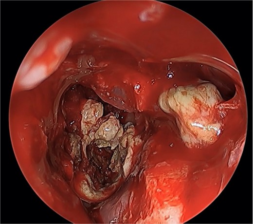 Endoscopic view of simultaneous occurrence of the fungal ball in maxillary and sphenoid sinuses.