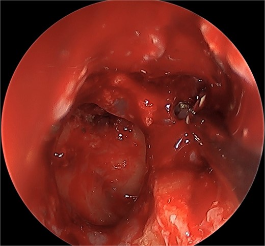 Post-operative endoscopic view post sphenoidectomy and maxillary antrostomy.