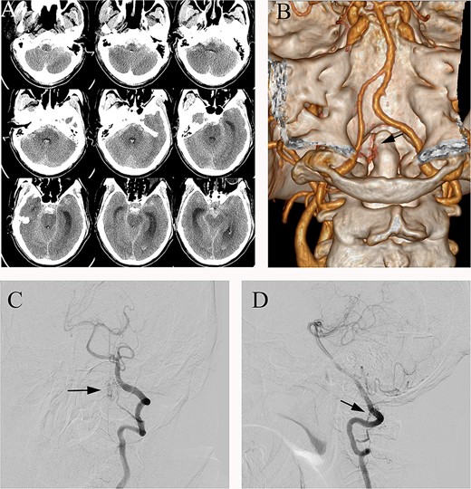 (A) Preoperative head CT, (B) CTA and (C, D) DSA identified the fistula (arrows) in the left lateral dural membrane and confirmed the intradural origin of the drainage vein.