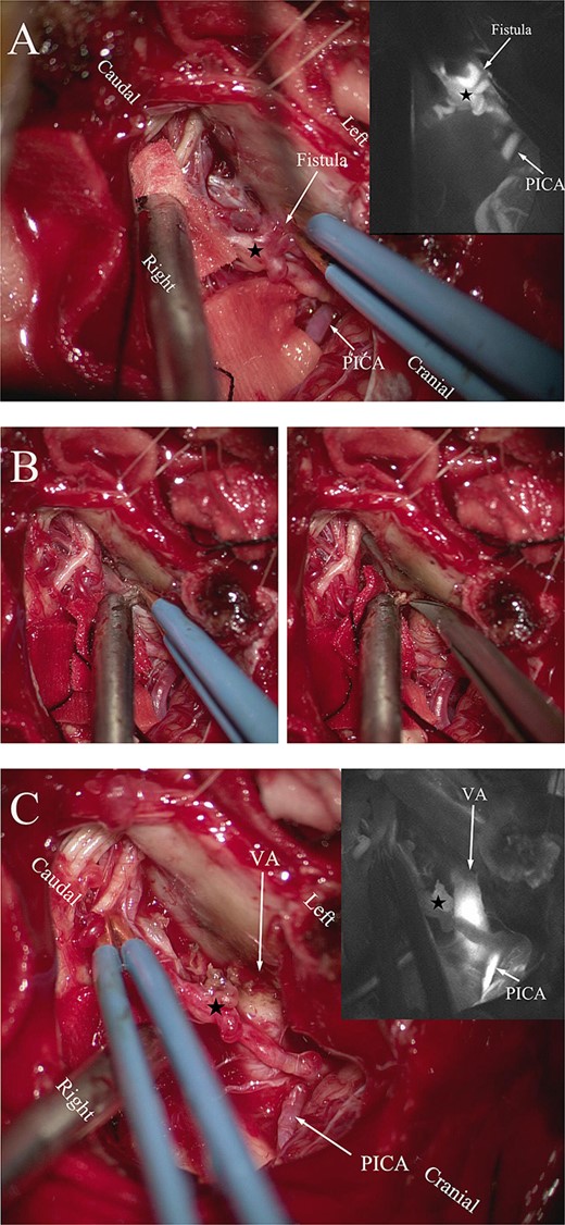 (A) Intraoperative ICG fluorescence imaging demonstrated that the fistula and abnormal drainage vein (asterisk) developed earlier than the posterior inferior cerebellar artery (PICA). (B) Coagulation of the origin of the abnormal drainage vein. (C) A subsequent ICG imaging confirmed the absence of fistula and drainage vein (asterisk) filling, with previously drainage veins developing later than the vertebral artery and PICA.