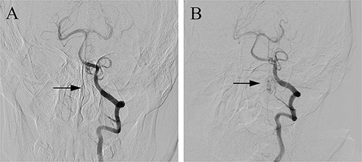 Postoperative DSA (A) confirmed the complete occlusion of the fistula (arrow) when compared with the preoperative DSA (B).