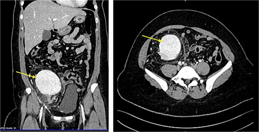 CT abdomen demonstrating the enlarged mass and its position by sagital and coronal sections (Arrow points at the mass).