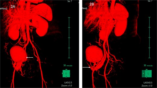 (A) CT abdomen with contrast demonstrating the mass in the right iliac fossa. (B) The image is rotated to show the blood supply from right external iliac artery and vein.