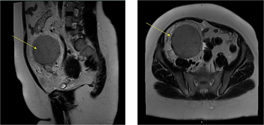 MRI abdomen signifying the mass and its location, extent in both views (Arrow points at the mass).