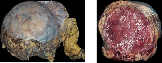 (A) Gross examination picture of retroperitoneal mass measuring. (B) Gross examination picture of the mass cut surfaces shows a cherry red and nodular texture.