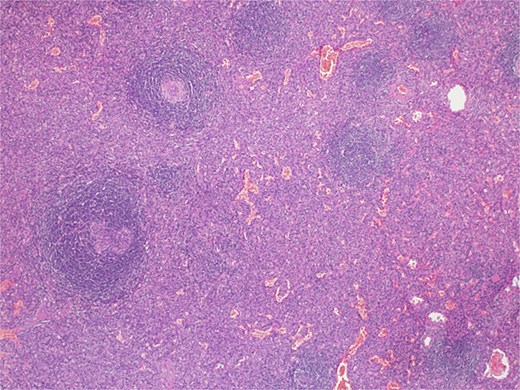 Microscopic examination picture confirmed the splenic tissue that included white and red pulps (hematoxylin & eosin stain 40×).