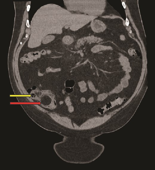 Coronal CT image, showing caecal lipoma (superior arrow) and ileo-caecal valve (inferior arrow).
