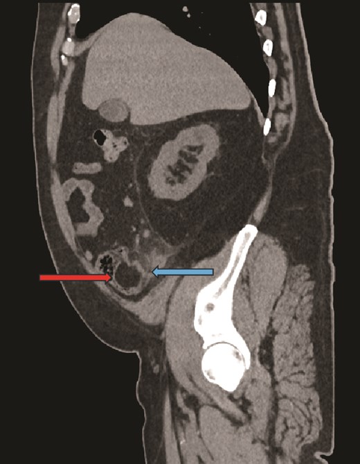 Sagittal CT image, showing caecal lipoma (right arrow) and appendicitis (left arrow).