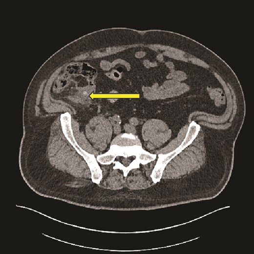 Axial CT image showing caecal inflammation and peri caecal stranding (arrow).