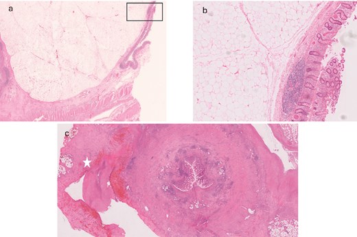 (a) Representative section of the 30 mm mass present at the appendiceal orifice; histology shows a diffuse unencapsulated submucosal mass consisting of sheets of adipocytes; (b) higher power of the area indicated in (a) confirms some mild variation in adipocyte size (likely a degenerate feature) but no evidence of lipoblasts, consistent with a benign submucosal colonic lipoma; (c) appendiceal mucosal ulceration with transmural inflammation, indicating an element of associated acute appendicitis; surrounding the appendix is fibrofatty tissue with extensive acute inflammation and areas of tissue infarction consistent with a peri-appendicular inflammatory mass (star).