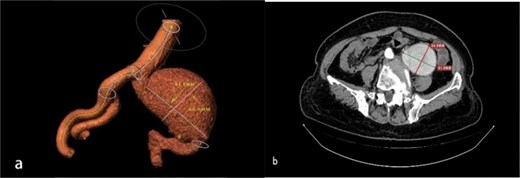 (a, b) Preoperative left common iliac artery aneurysm size and location.