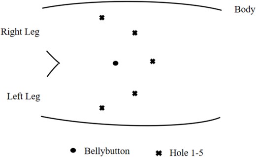 Schematic illustration of the position of the five laparoscopic ports.