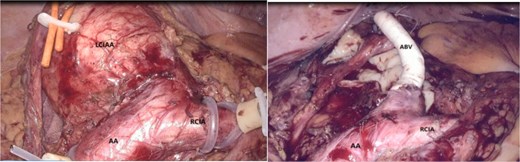 (a, b) Laparoscopic visualization of iliac artery aneurysms (AA abdominal aorta, RCIA right common iliac artery, LCIAA left common iliac artery aneurysm, ABV artificial blood vessel).