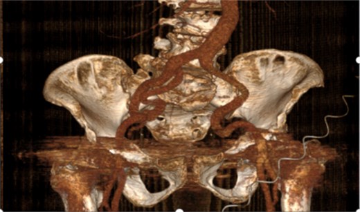 Postoperative CT showing the left common iliac artery aneurysm being repaired with the artificial graft in situ and left internal iliac artery being ligated.