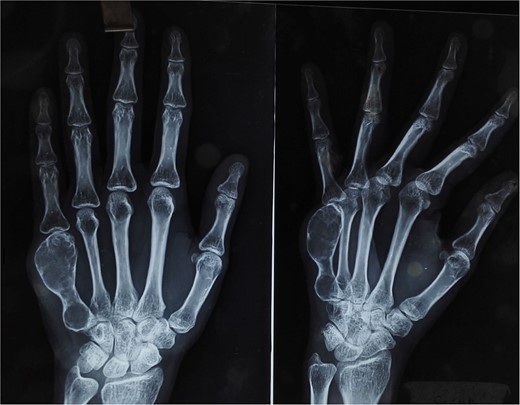 X-ray of the right hand shows an expansile, lytic lesion in the diaphysis of the fifth metacarpal with a “paper-thin” cortex extending to the subchondral bone.
