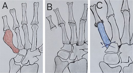 Scheme of the tumor resection and reconstruction technique with metatarsus osteoarticular graft; (A) the red shaded metacarpal indicates tumor; (B) hand after tumor resection, in which the capsule and ligaments at the MCP joint are seen; (C) free metatarsus with its capsular insertions sutured with capsule and ligaments at recipient site with k-wire fixation proximally.