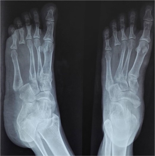 Post-operative radiograph showing preserved joint space and structure of transferred metatarsal.