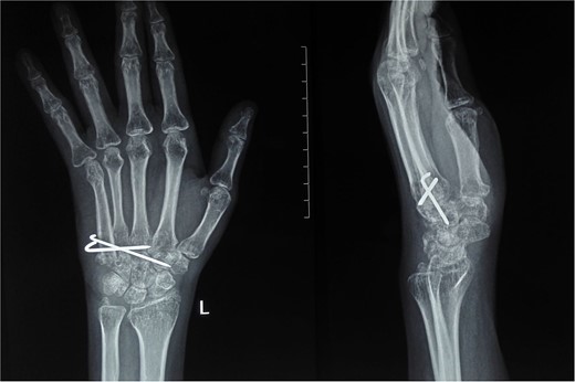 Donor site from where fourth metatarsus was harvested.