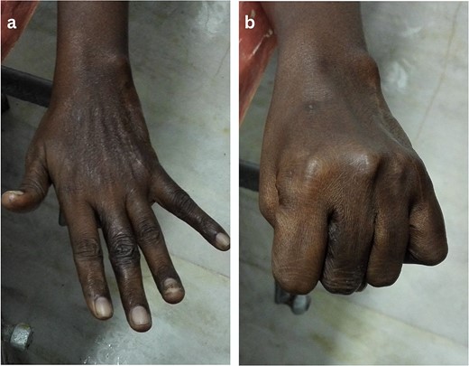 Hand function after 2 years (a; extension, b; flexion).