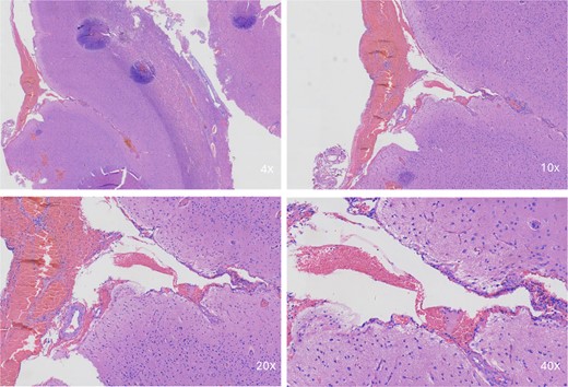 Intraoperative pathological images. Microscopic image showing a portion of the brain tissue with haemorrhagic areas. The vascular morphology in the lesion is irregular, with an indistinct hierarchical vascular wall structure and multiple lumen sizes.