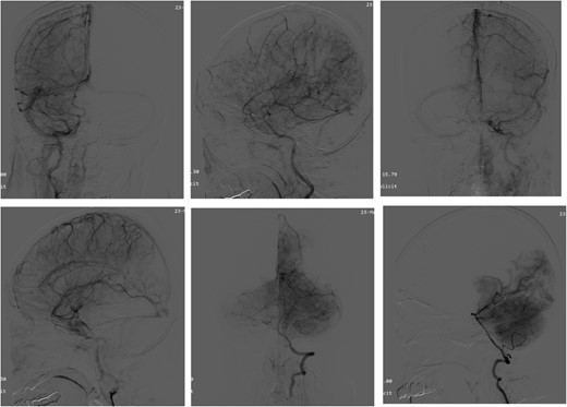 Angiography of the brain. Brain angiography showing obvious vascular malformations.