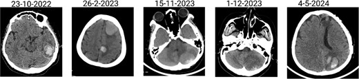 Brain CT scan showing multiple previous haemorrhagic lesions in the brain parenchyma with evidence of chronicity.