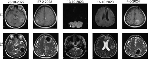 Brain MRI showing dynamic haemorrhage. (a) T2-weighted MR image showing multiple CCMs. The highlighted portions indicate areas of hemosiderin deposition associated with previous haemorrhages. (b) post-contrast T1-weighted MR images showing the enhancement patterns of CCMs and the extent of the surrounding oedema.