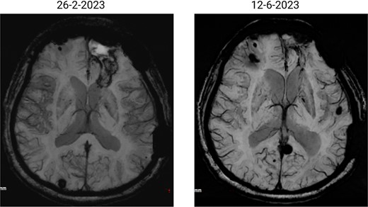 SWI images of the brain. Brain angiography showing obvious vascular malformations. SWI images of the brain showing multiple haemorrhagic lesions with some active bleeding.