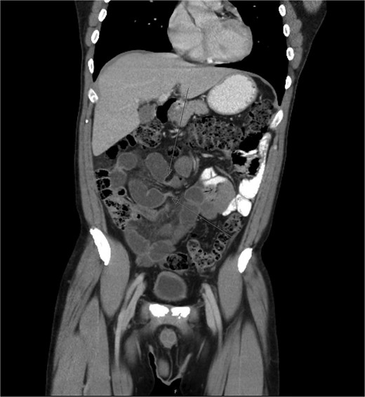 Abdominal CT scan demonstrating closed-loop small bowel obstruction involving jejunal loops, with two distinct transition points indicated by arrows.