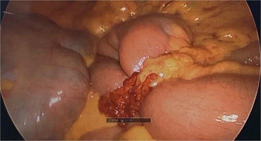 Intraoperative image from diagnostic laparoscopy showing a loop of jejunum herniating through a defect in the greater omentum.