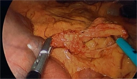 Intraoperative image showing the omental defect after reduction of the herniated loop of jejunum.