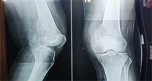 The X-ray shows a distal femur osteolytic lesion with a soap bubble appearance, a narrow zone of transition, a soft tissue component, and a sparing knee joint in the X-ray taken 6 months before pregnancy.
