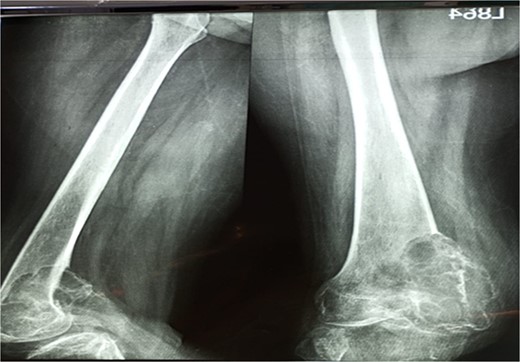 X-ray that was taken 4 months before presentation showing the tumor was very aggressive with a narrow zone of transition, and mass is progressively increased.