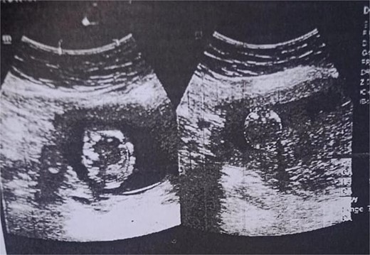 Ultrasound confirmation of pregnancy.