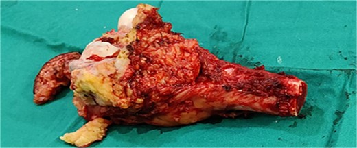 Marginal resected tumor margin and frozen section were taken for confirmation of tumor margin.