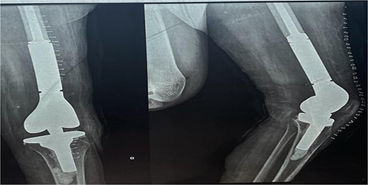 The X-ray after surgery showed a mega prosthesis with good implant alignment.