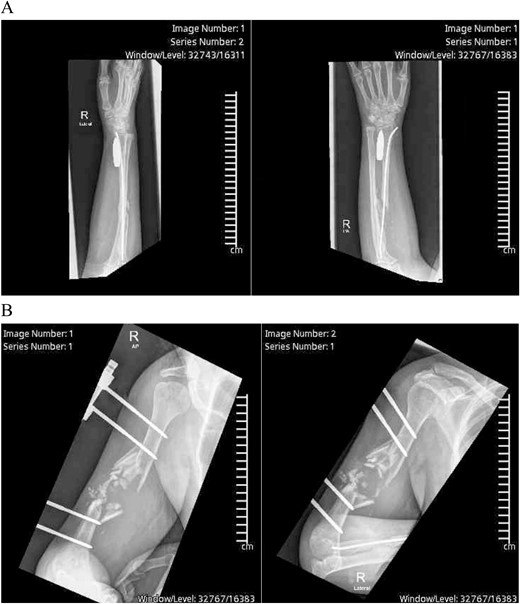 (A) Preoperative X-ray showing the bullet lodgment along the volar aspect of the distal radius. (B) Preoperative X-ray showing the external fixation device with pins at the proximal and distal ends of the right humerus with shattered mid-third of the shaft, surrounded by displaced fracture fragments, which was shattered along the bullet’s tract before settling in the wrist.