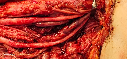 Intraoperative X-ray showing severe adhesions of the radial, median and ulnar nerves in the proximal 2/3rd of the arm, adhesions were lesser as the nerves coursed distally in the lower arm and proximal forearm.