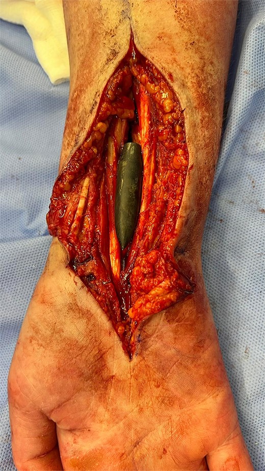 Intraoperative X-ray showing the final position of the bullet on the volar aspect of the radius.