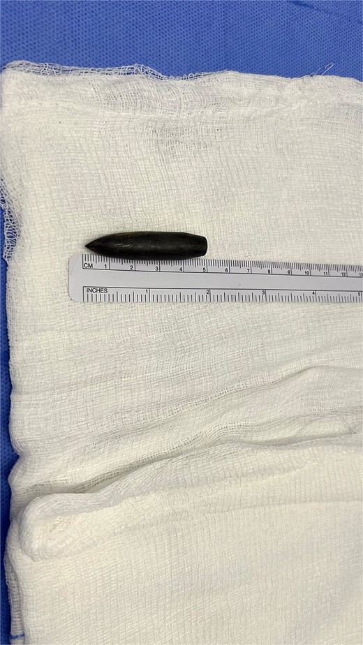 The bullet post extraction with a length of 5 centimeters.