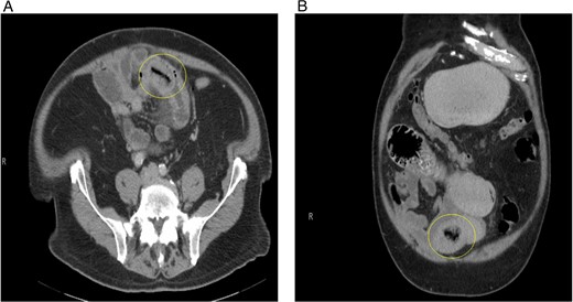 (A) Initial CT abdomen (transverse view) revealing what was thought to be intussusception but turns out to be primary enterolith with an air filled core. (B) Initial CT abdomen (coronal view) revealing what was thought to be intussusception but turns out to be primary enterolith with an air filled core.