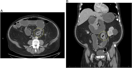 (A) Repeat CT scan (transverse view) on readmission revealing the same primary enterolith with the core pit that mimics intussusception. (B) Repeat CT scan (coronal view) on readmission revealing the same primary enterolith with the core pit that mimics intussusception.
