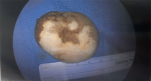 Round primary enterolith extracted from the second diagnostic laparoscopy. The removal of this stone lead to full resolution of GI symptoms for this patient.