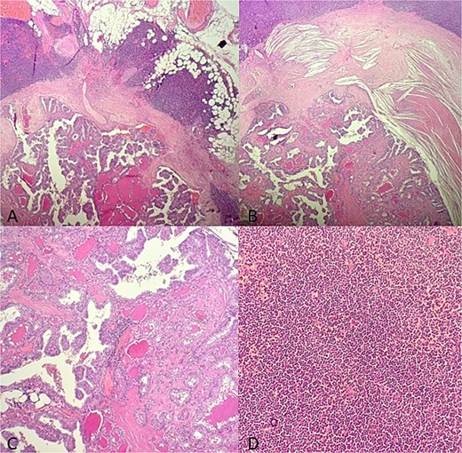 Microscopic findings (A–B): HE X 10: A papillary thyroid carcinoma metastasis into a lymph node involved with a small lymphocytic lympha extending beyond the adipose tissue; (C): HE X 20: Papillary and follicule structure lined with cells showing papillary nuclear atypia; (D): HE X 20: Diffuse small cell lymphoma proliferation.