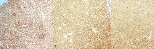 Immunohistochemistry findings. (A) Diffuse and strong membranous staining of lymphomatous cells for CD20; (B) diffuse and strong membranous staining of lymphomatous cells for CD5; (C) diffuse and strong membranous staining of lymphomatous cells for CD23.